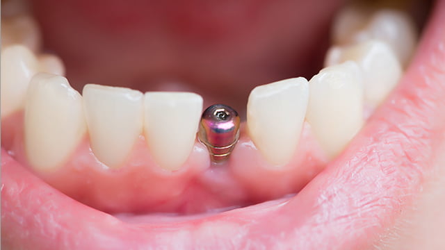 イメージ図：周囲の健康な歯を守れる