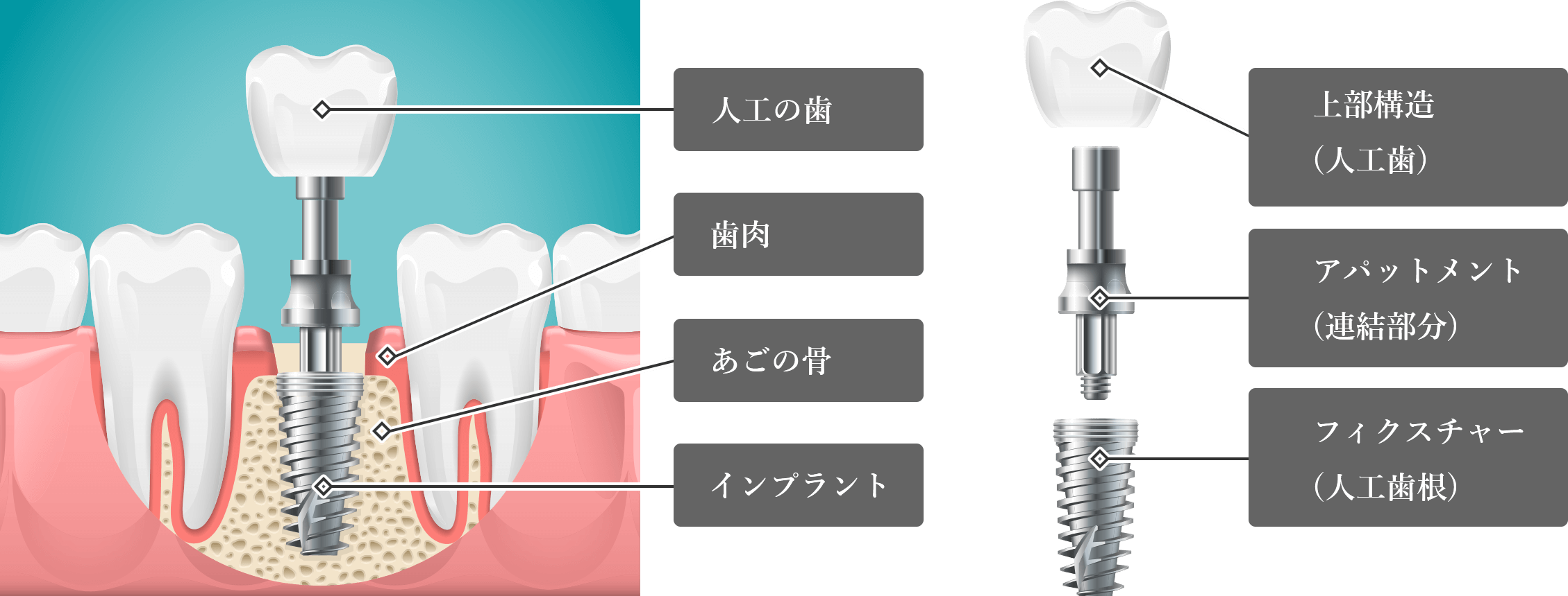 構造の図解：上部構造（人工歯）、アバットメント（連結部分）、フィクスチャー（人工歯根）