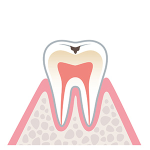 表面のエナメル質に穴が空いたむし歯