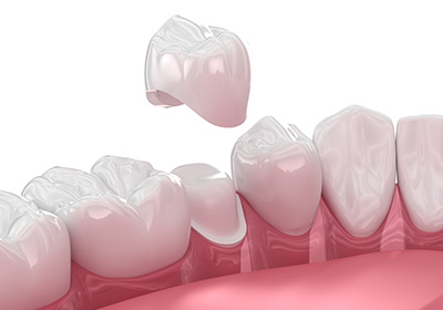 補綴カウンセリング・機能回復